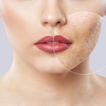 Problemi dermatologici Acne
